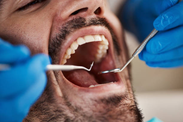 Best Emergency Wisdom Teeth Removal in Fruitport, MI